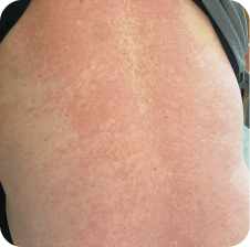 Drug rash on back