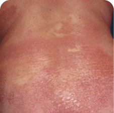 Skin lesions in MF and SS on torso