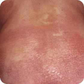 Example of Erythroderma in Sézary Syndrome