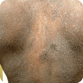 Example of Exfoliative erythroderma in Sézary Syndrome
