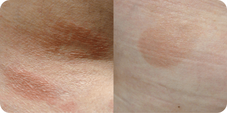 Example of Mycosis Fungoides patch