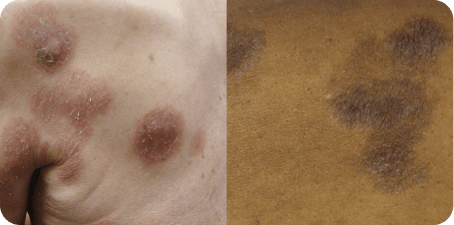 Example of Mycosis Fungoides plaque