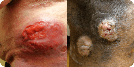Example of Mycosis Fungoides tumor