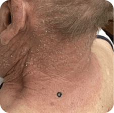 Drug rash on neck