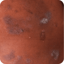 Skin lesions in MF and SS on torso