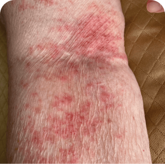 Drug rash on arm