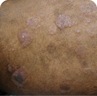Skin lesions on back