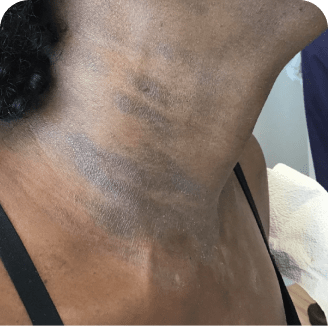 Drug rash on neck