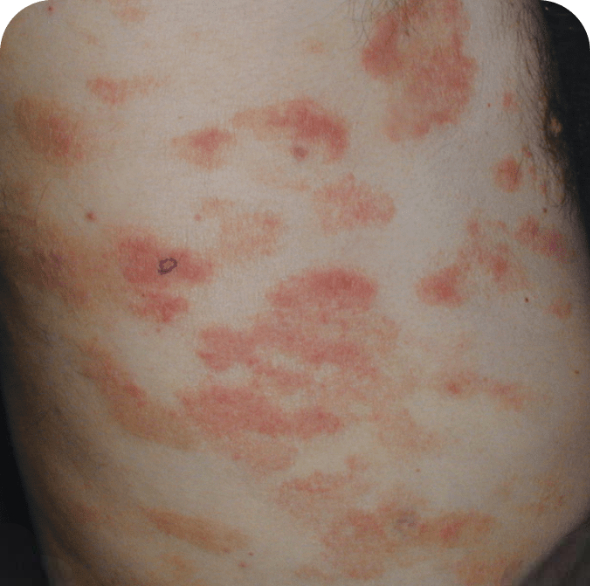 Skin lesions in MF and SS on back
